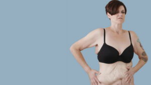 My Extreme Excess Skin
