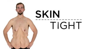 My Extreme Excess Skin