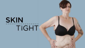 My Extreme Excess Skin