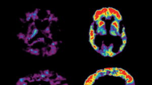 The Alzheimer’s Project