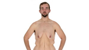 My Extreme Excess Skin